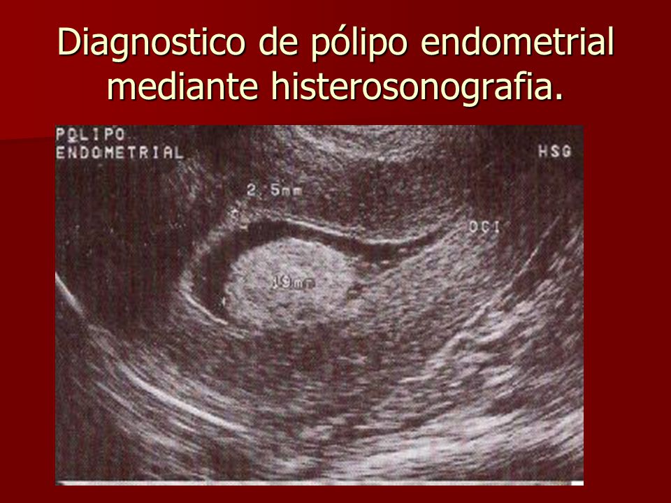 diferencia entre polipo y mioma endometrial diferencia entre polipo y mioma endometrial